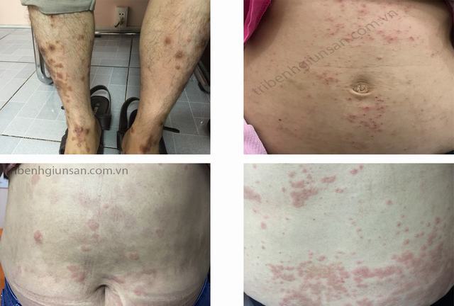 Dấu hiệu bệnh sán chó mèo