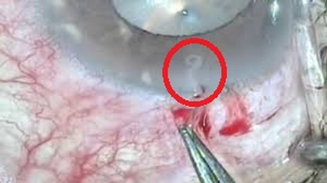 Bệnh sán chó Toxocara: Nguyên nhân, triệu chứng và điều trị
